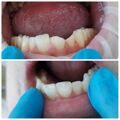 Реставрация зуба в зоне улыбки